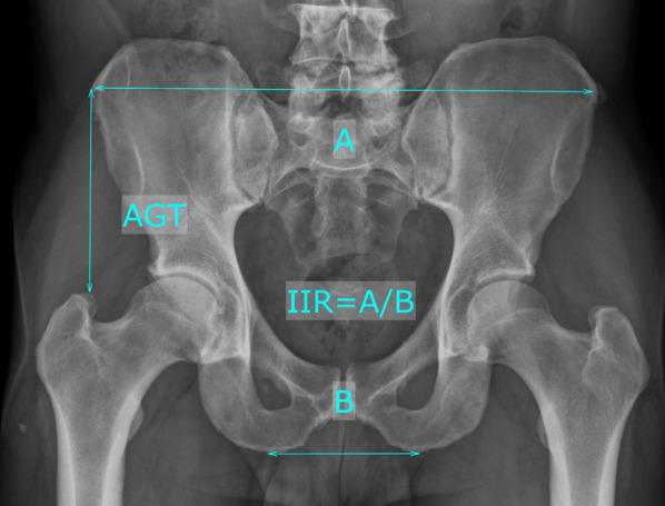 Is there a difference in pelvic and femoral morphology in early periprosthetic femoral fracture in cementless short stem total hip arthroplasty via an anterolateral approach?