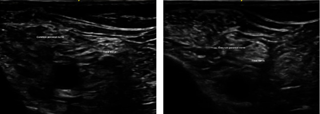 Surgeon-Administered Ultrasound-Guided Regional Anesthesia in Fixation of Distal Fibula Fracture.