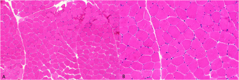 Adult late-onset limb-girdle muscular dystrophy R1/2A complicated by parathyroid adenoma and sick sinus syndrome: a case report and literature review.