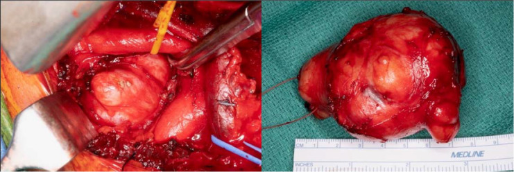 Unexpected Mediastinal Mass Etiology in B-Acute Lymphoblastic Leukemia.