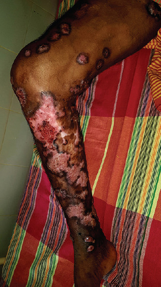 Chromoblastomycosis is curable with DAT therapy (debulking, intralesional amphotericin B, oral terbinafine); case series of 16 patients.