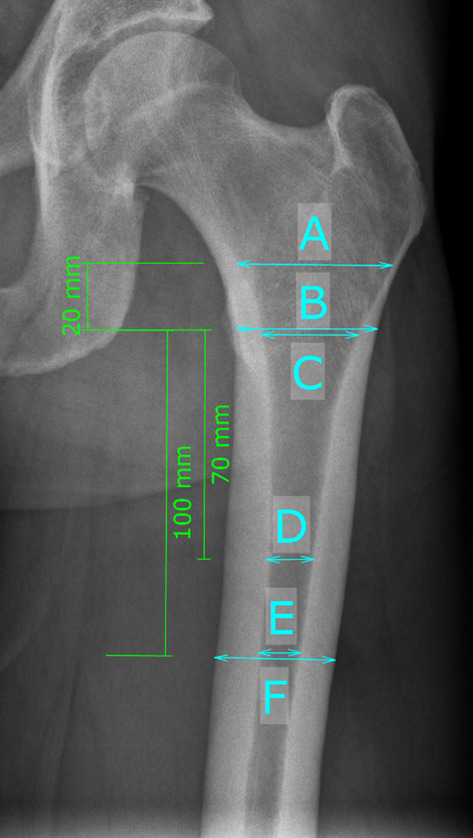 Is there a difference in pelvic and femoral morphology in early periprosthetic femoral fracture in cementless short stem total hip arthroplasty via an anterolateral approach?