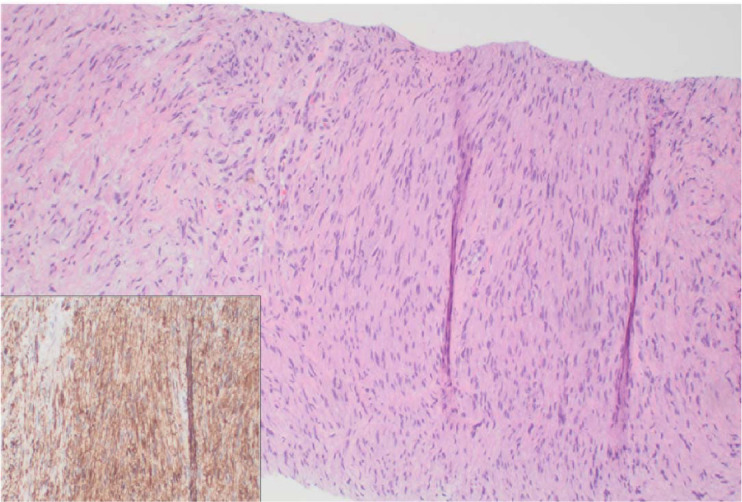 Unexpected Mediastinal Mass Etiology in B-Acute Lymphoblastic Leukemia.