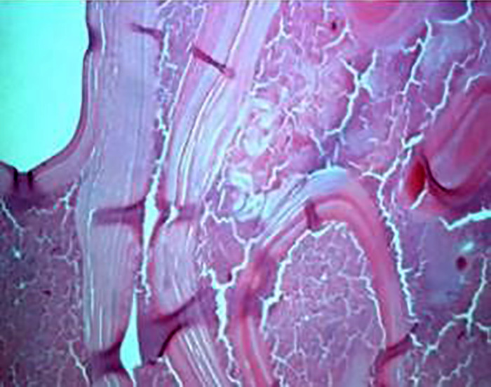 Disseminated Abdominal Cystic Echinococcosis After Blunt Abdominal Trauma: A Case Report.
