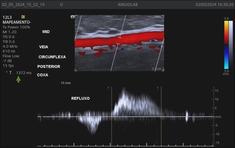 The role of the giacomini vein in preoperative mapping of lower limb varicose veins.