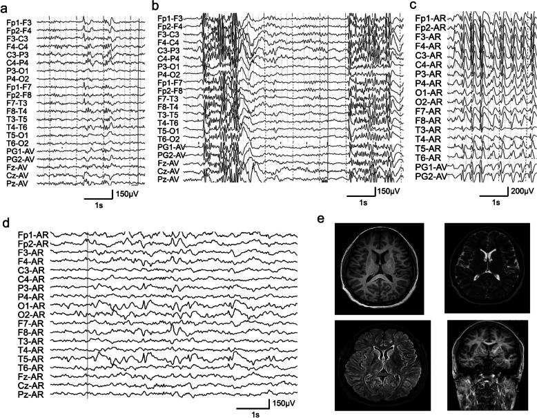 Variants of TSC1 are associated with developmental and epileptic encephalopathy and focal epilepsy without tuberous sclerosis : For the China Epilepsy Gene 1.0 Project.