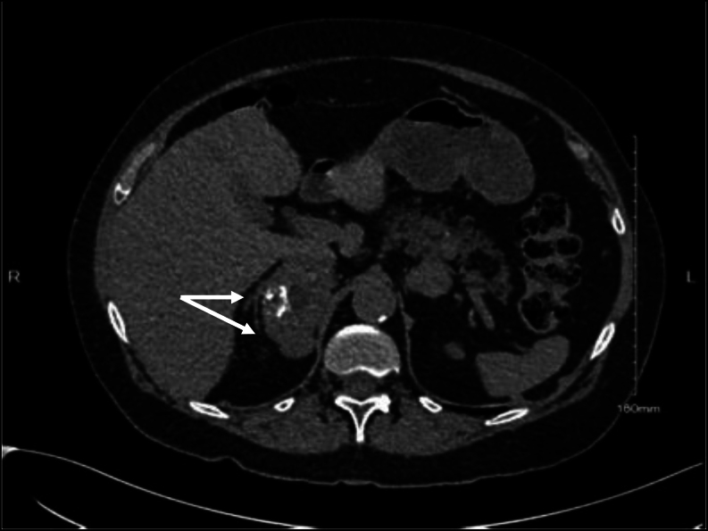 Extra-adrenal adrenocortical cancer associated with multiple endocrine neoplasia type 1.