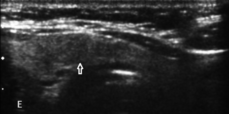 Medullary Thyroid Carcinoma in the Background of Non-neoplastic Toxic Nodular Goiter