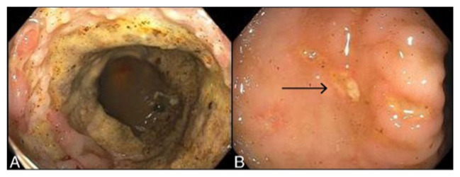 Sevelamer-induced Gastrointestinal Mucosal Injury: A Critical Review for Clinicians.