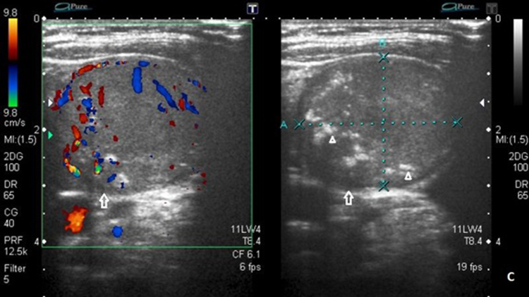 Medullary Thyroid Carcinoma in the Background of Non-neoplastic Toxic Nodular Goiter