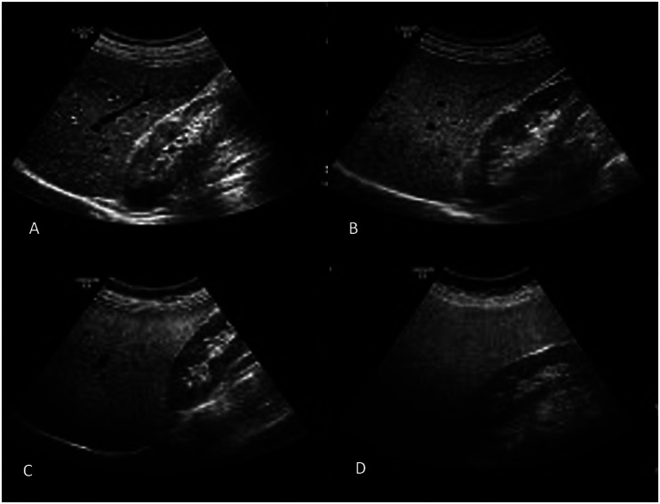 Metabolic Dysfunction Associated Fatty Liver Disease in Long-Term Cholecystectomy Patients: A Cross-Sectional Study.