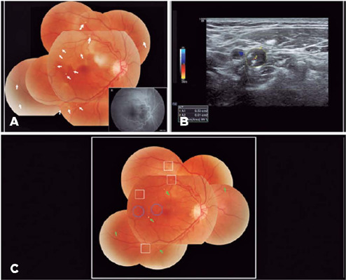 Multiple visible retinal emboli in branch retinal artery occlusion secondary to internal carotid artery occlusion.