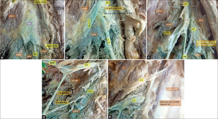 The Investing Layer of the Deep Cervical Fascia: An Alternative Site for Ultrasound-guided Supraclavicular Nerve Block - A Cadaveric Anatomical Study.