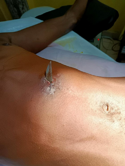 [Abdominal parietal abscess secondary to the absorption of a knife by a mental patient, Treichville University Hospital, Côte d'Ivoire].