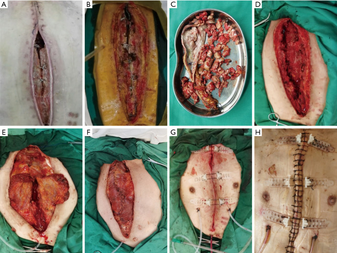 Treating deep sternal wound infection with pectoralis major flap transposition: a systemic factor analysis of efficacy and safety.