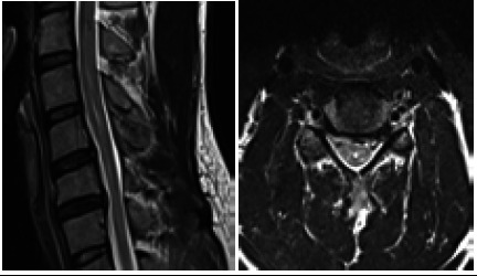 Hirayama Disease in a Young Male: A Case Report.