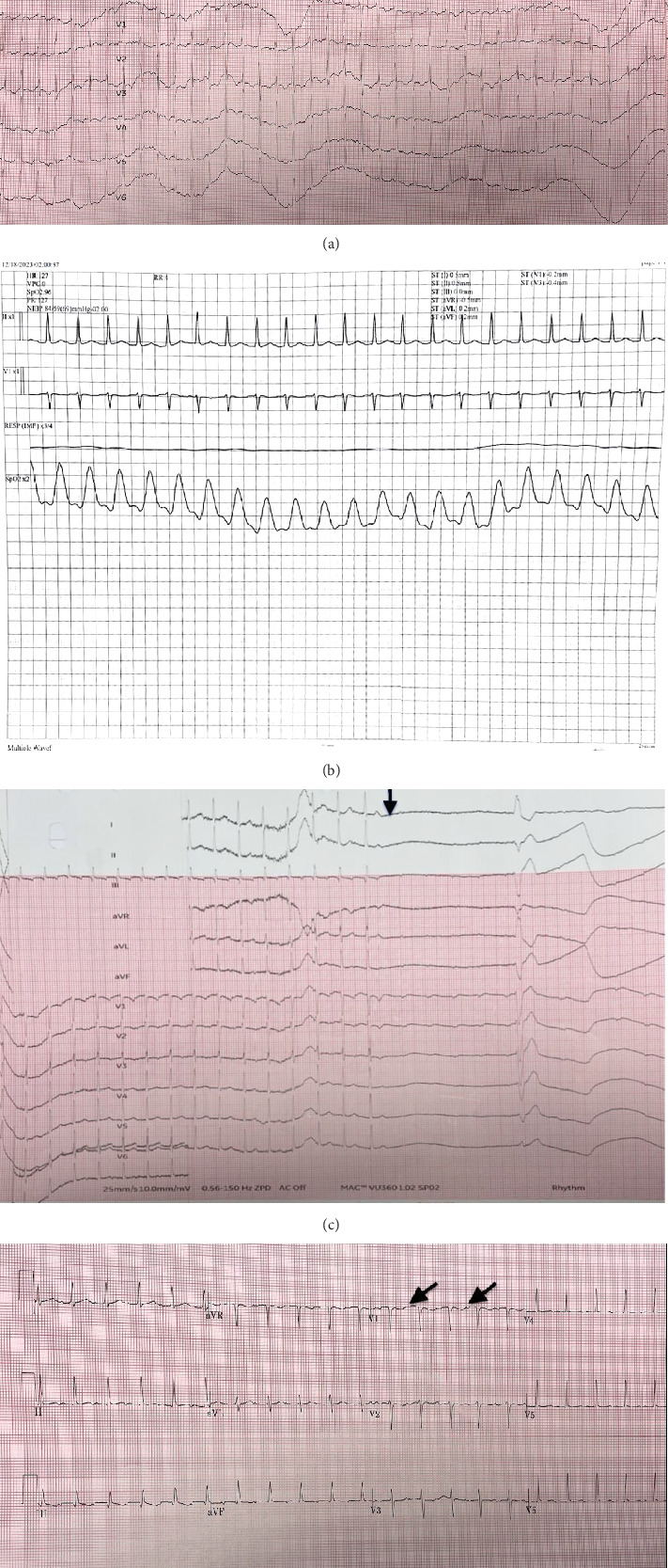 A Case of Atrial Tachycardia Masquerading as Sinus Tachycardia in a Pregnant Female-A Case Report.