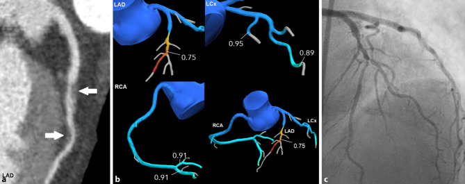 Non-invasive physiological assessment of coronary artery obstruction on coronary computed tomography angiography.