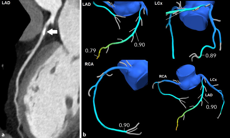 Non-invasive physiological assessment of coronary artery obstruction on coronary computed tomography angiography.