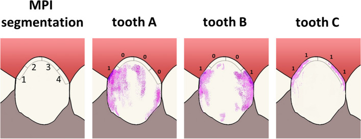 Making plaque assessment easier - a validation study of simplified versions of the Marginal Plaque Index.