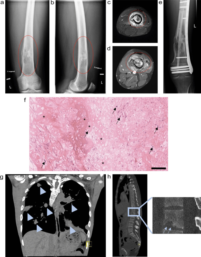 Tissue-engineered patient-derived osteosarcoma models dissecting tumour-bone interactions.