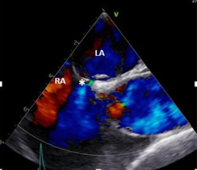 Transcatheter Closure of a Patent Foramen Ovale With a Small Adjacent Atrial Septal Defect and a Double Interatrial Septum Post Cryptogenic Stroke.