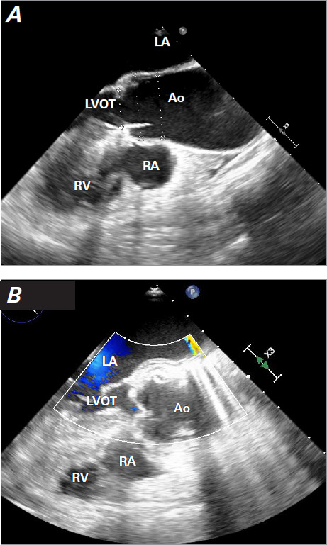 Transcatheter Aortic Valve Implantation Bailout for Severe Aortic Insufficiency due to Aortic Root Dissection Following Ascending Aortic Aneurysm Repair.