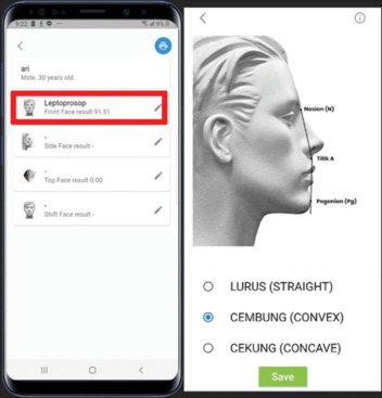 Facialprofile determination using a novel face analyzer orthodontic mobile application.
