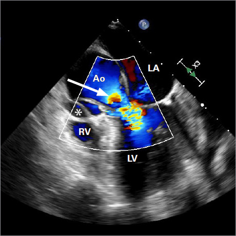 Transcatheter Aortic Valve Implantation Bailout for Severe Aortic Insufficiency due to Aortic Root Dissection Following Ascending Aortic Aneurysm Repair.