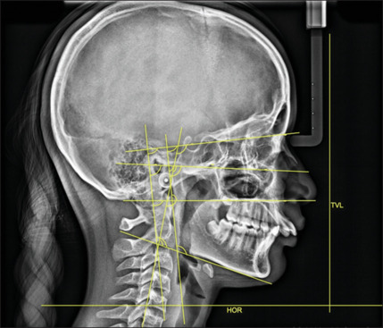 Effect of Forsus-assisted mandibular advancement on the adaptation of craniocervical posture - A retrospective study.