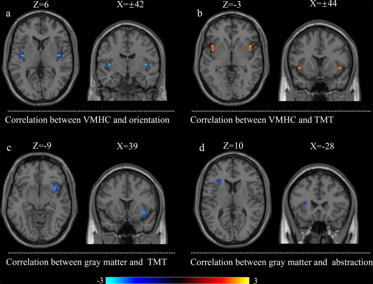 Altered structural and functional homotopic connectivity associated with cognitive changes in SLE.