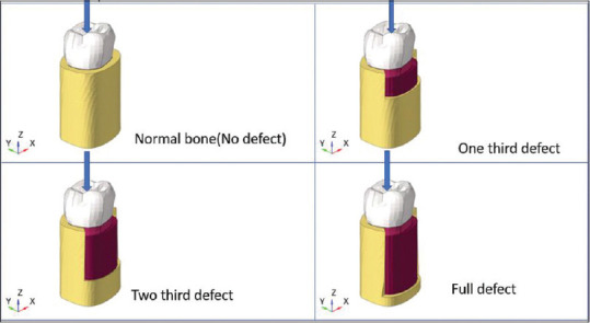 Effect of osseous defect on periodontal ligament stress under normal masticatory force: A three-dimensional finite element analysis of mandibular second molar.