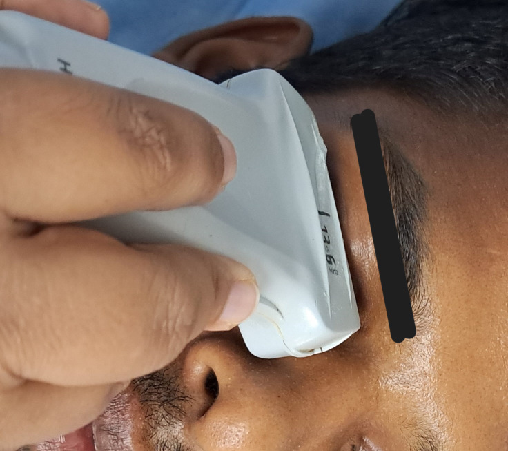 Correlation of Point of Care Ultrasound (POCUS) Guided Pupillary Assessment Parameter with Glasgow Coma Scale in Patients with Altered Mental Status- A Cross Sectional Study.
