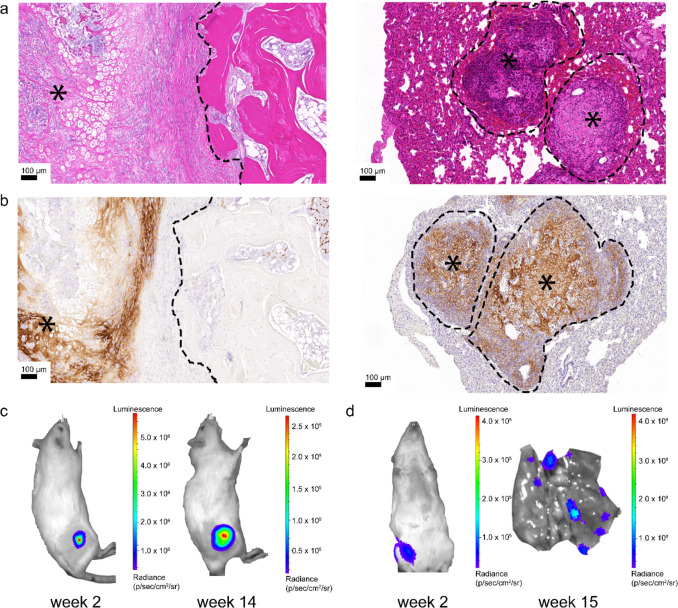 Tissue-engineered patient-derived osteosarcoma models dissecting tumour-bone interactions.
