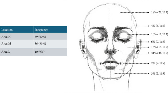 Nonmelanoma Skin Cancer in the Heart of the Middle East: Analysis of Mohs Micrographic Surgery Cases From a Tertiary Care Center in Lebanon.