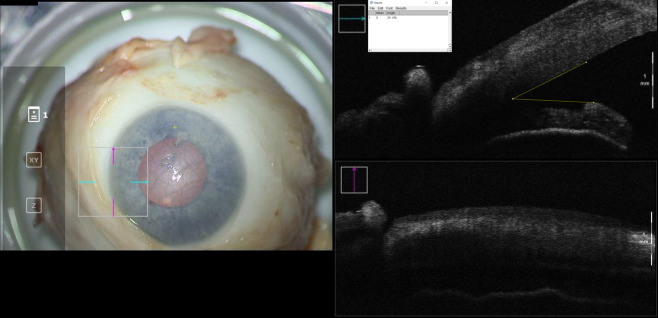 Intraoperative optical coherence tomography imaging for assessment of anterior chamber gas fill.