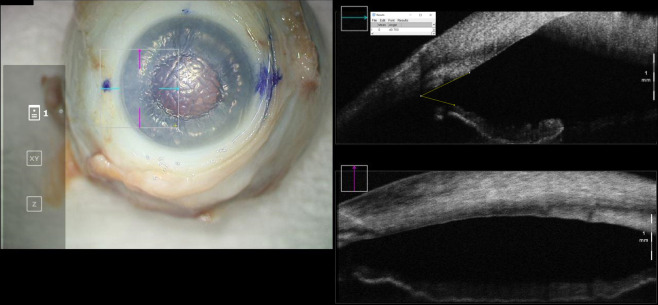 Intraoperative optical coherence tomography imaging for assessment of anterior chamber gas fill.