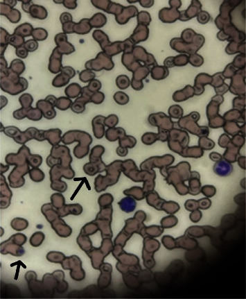 Tick Tock-A Matter of Time: Two Cases of Babesia Acquired in Urban Newark, NJ.