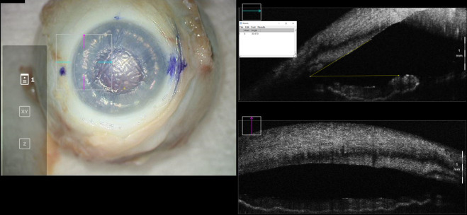 Intraoperative optical coherence tomography imaging for assessment of anterior chamber gas fill.