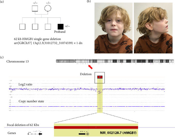 A Case Report on 13q12.3 Microdeletion Syndrome Caused by <i>HMGB1</i> Haploinsufficiency.