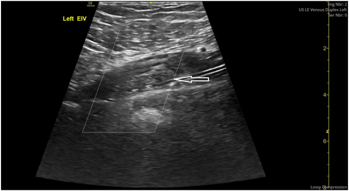 Extensive Deep Vein Thrombosis in a Young Man Taking Tirzepatide for Weight Loss