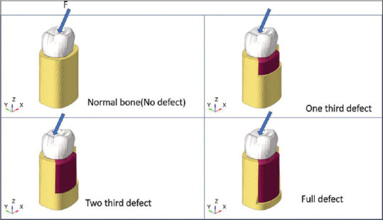 Effect of osseous defect on periodontal ligament stress under normal masticatory force: A three-dimensional finite element analysis of mandibular second molar.