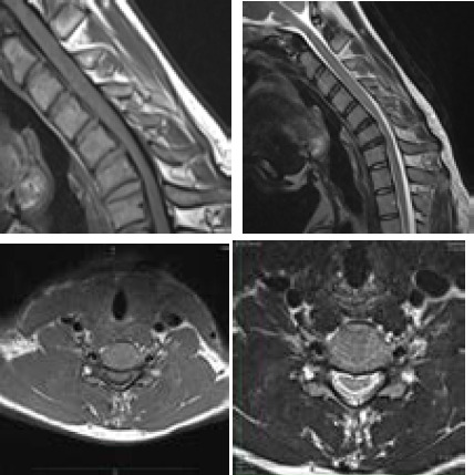 Hirayama Disease in a Young Male: A Case Report.