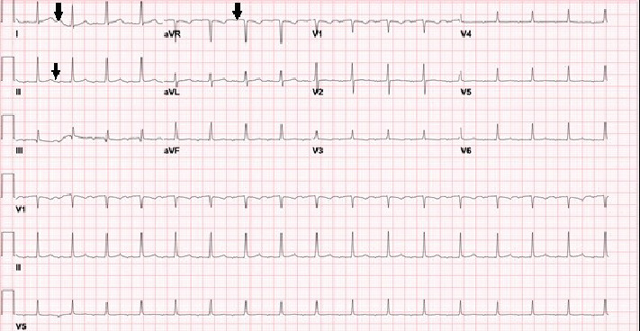 A Case of Atrial Tachycardia Masquerading as Sinus Tachycardia in a Pregnant Female-A Case Report.