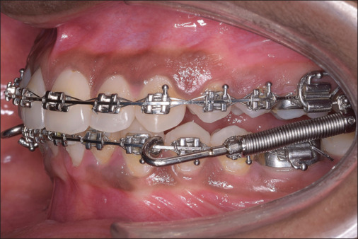 Effect of Forsus-assisted mandibular advancement on the adaptation of craniocervical posture - A retrospective study.