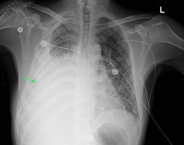 Pulmonary Kaposi Sarcoma in the Era of Antiretroviral Therapy: A Case Series.