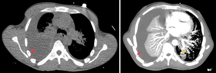 Pulmonary Kaposi Sarcoma in the Era of Antiretroviral Therapy: A Case Series.