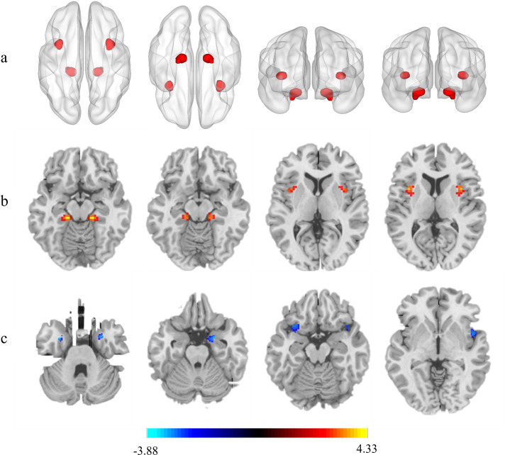 Altered structural and functional homotopic connectivity associated with cognitive changes in SLE.