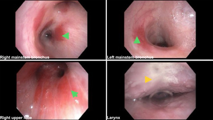 Pulmonary Kaposi Sarcoma in the Era of Antiretroviral Therapy: A Case Series.