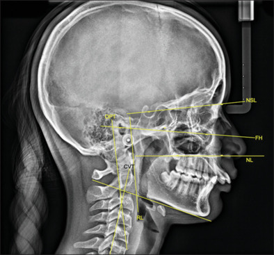 Effect of Forsus-assisted mandibular advancement on the adaptation of craniocervical posture - A retrospective study.